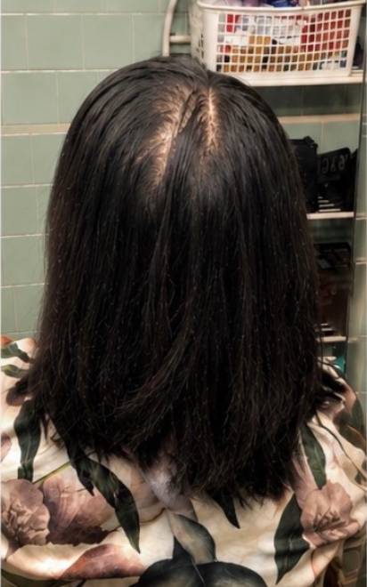 Before Treatment