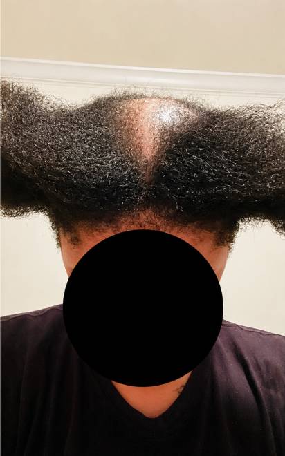 Before Treatment
